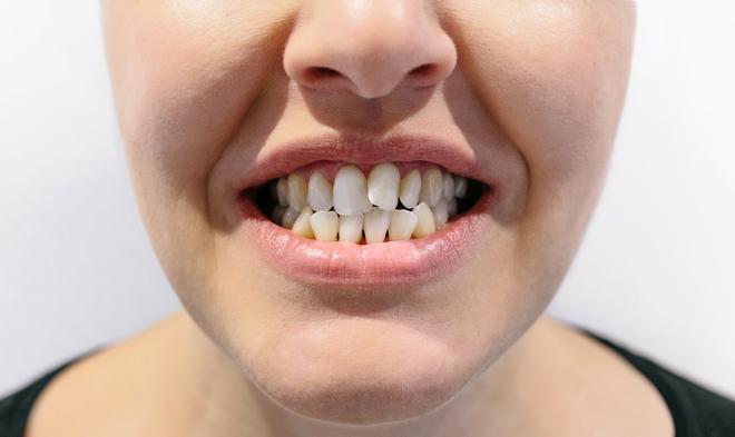crooked teeth
